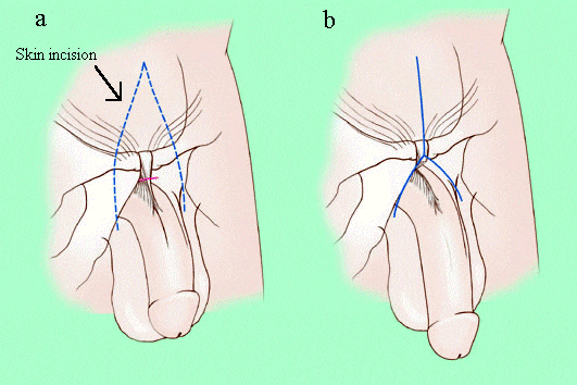 Tendon în penis - Ligament suspensor intins/rupt